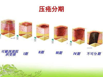 最新压疮分期研究，临床意义与进展探索